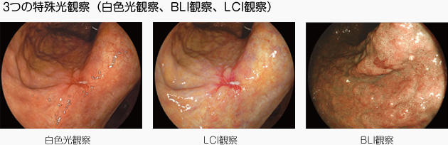 3つの特殊光観察（白色光観察、BLI観察、LCI観察）