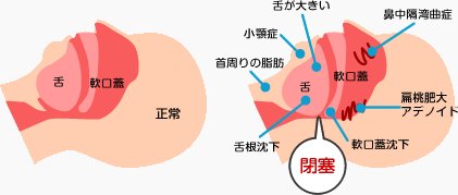 睡眠時無呼吸症候群の原因