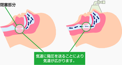 睡眠時無呼吸症候群のCPAP（シーパップ）療法